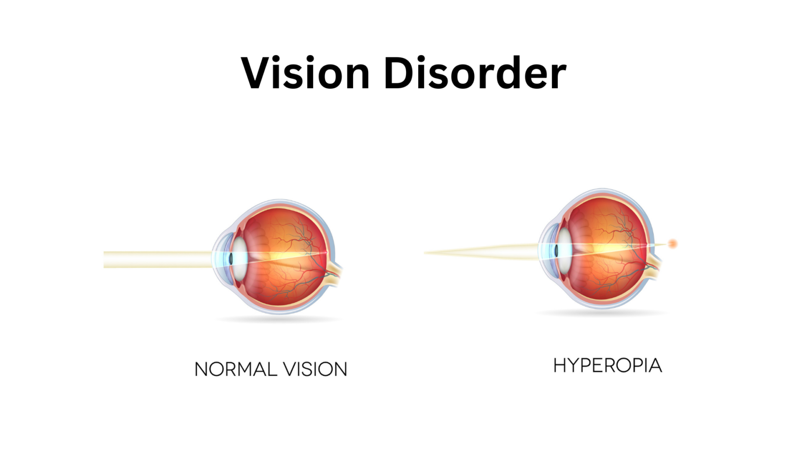 LASIK Hyperopia