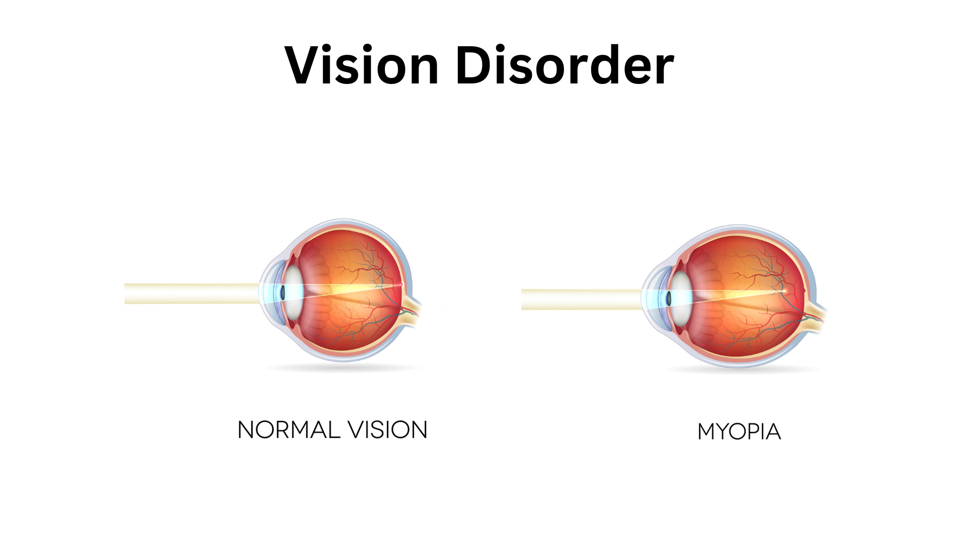 LASIK Myopia