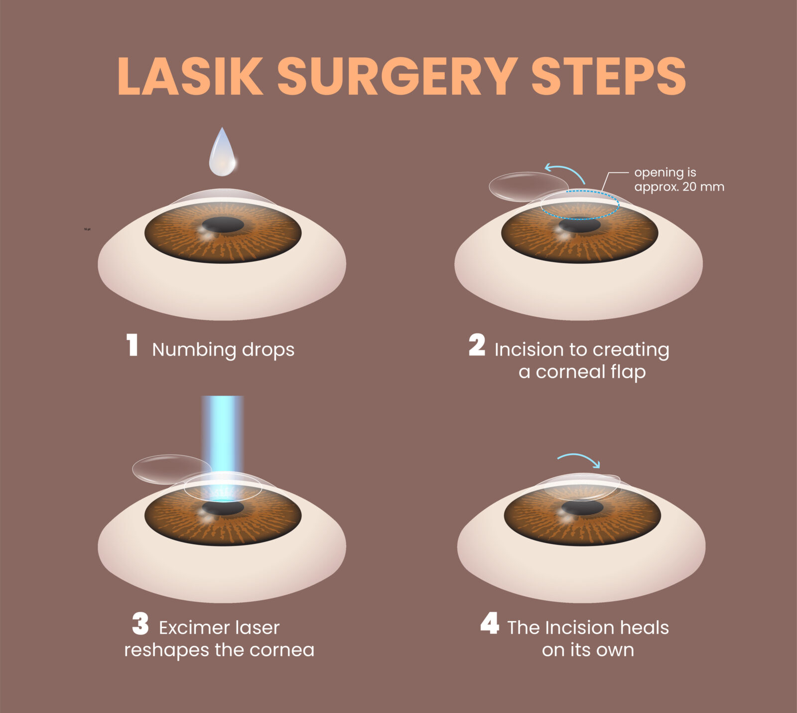 LASIK eye surgery